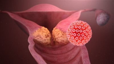 İnsan Papillomavirusu (Hpv): Genital Ziyillər, Uşaqlıq Boynu Xərçəngi, Hpv Peyvəndi