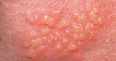 Genital Herpes nədir? Necə yaranır? Necə müalicə olunur?