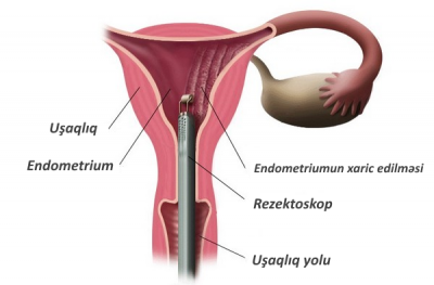 Endometriumun ablasiyası (rezeksiyası)