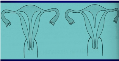 Uşaqlıqdaxili arakəsmə